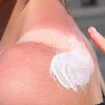 Sonnenbrand ist gefährlich - es drohen Langzeitfolgen.